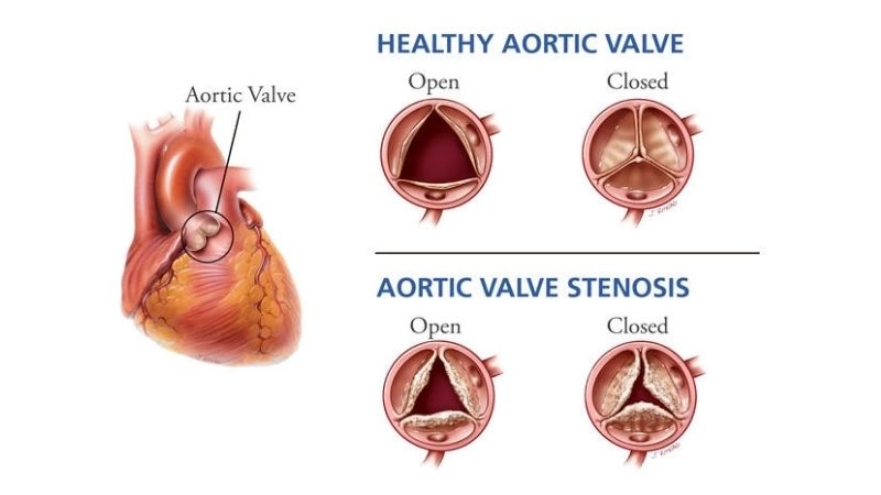 Aortic Stenosis Diagnosis confirmed with echocardiogram