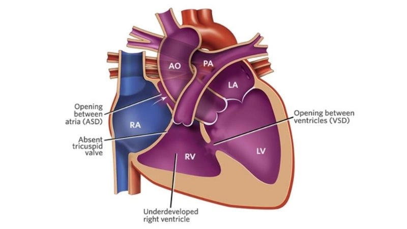 Aortic valve atresia treatment medical and surgical care