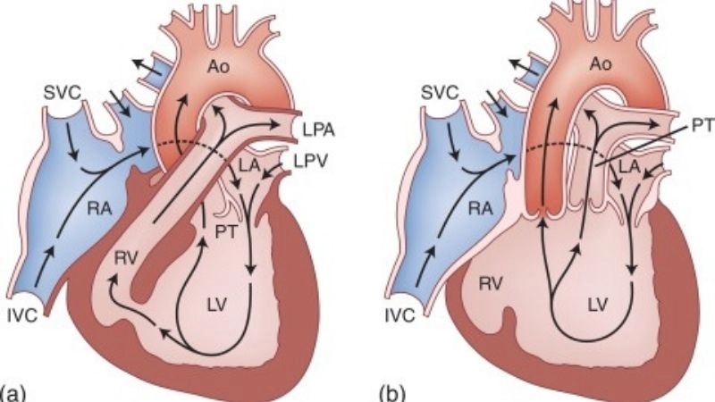 Aortic valve atresia life expectancy survival outlook