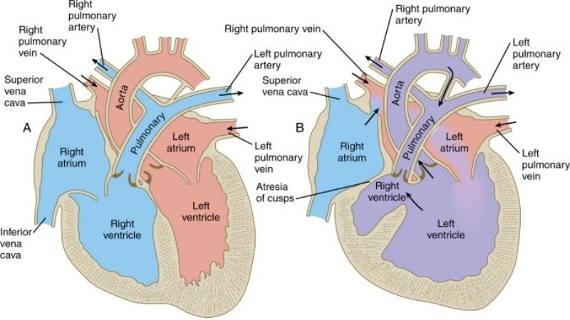 Aortic valve atresia in infants diagnosis and management