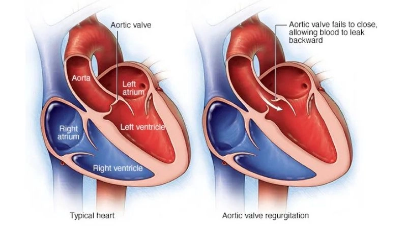 Aortic valve atresia and pregnancy risks and outcomes