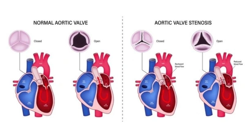 Aortic valve atresia prognosis long term outlook