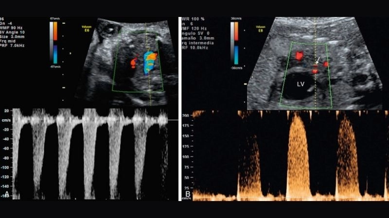Aortic valve atresia causes genetic and developmental factors