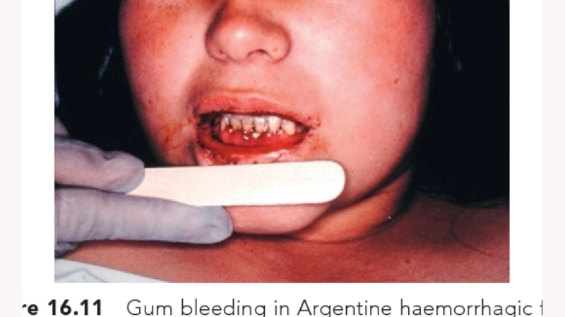Argentine Hemorrhagic Fever Arenaviridae risk