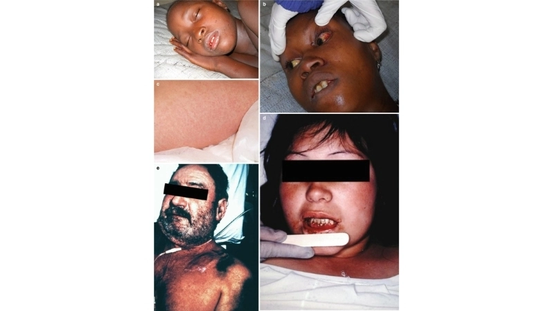 Argentine Hemorrhagic Fever rodent reservoir threat