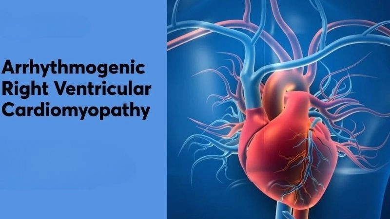 ARVC symptoms include palpitations and fainting