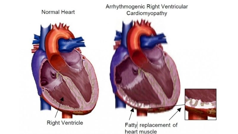 Arrhythmogenic Right Ventricular Cardiomyopathy diagnosis uses ECG, MRI, and genetics