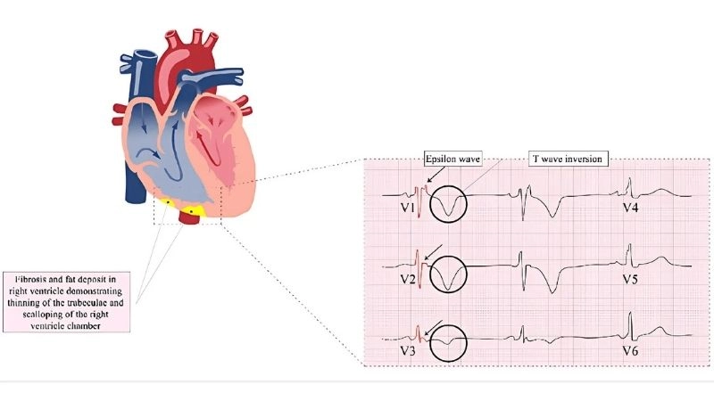 Arrhythmogenic Right Ventricular Cardiomyopathy and exercise can trigger dangerous rhythms