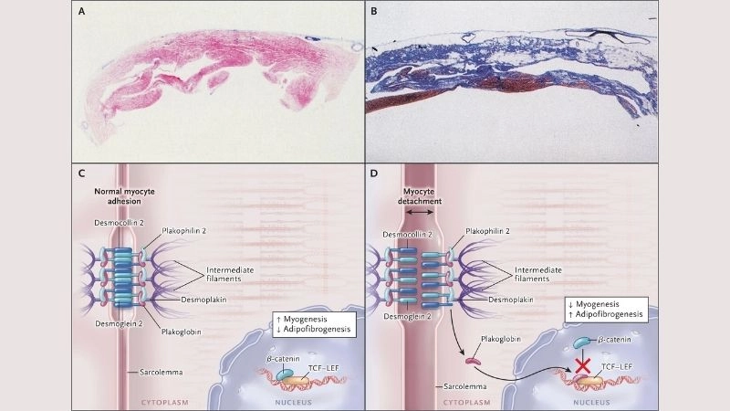 Arrhythmogenic Right Ventricular Cardiomyopathy ICD prevents sudden cardiac death