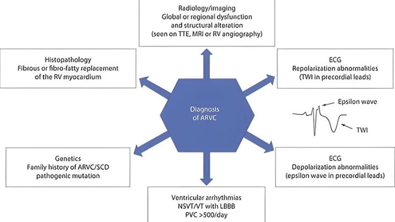 ARVC sudden death is a major concern
