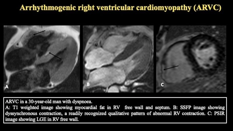 ARVC research explores new treatments