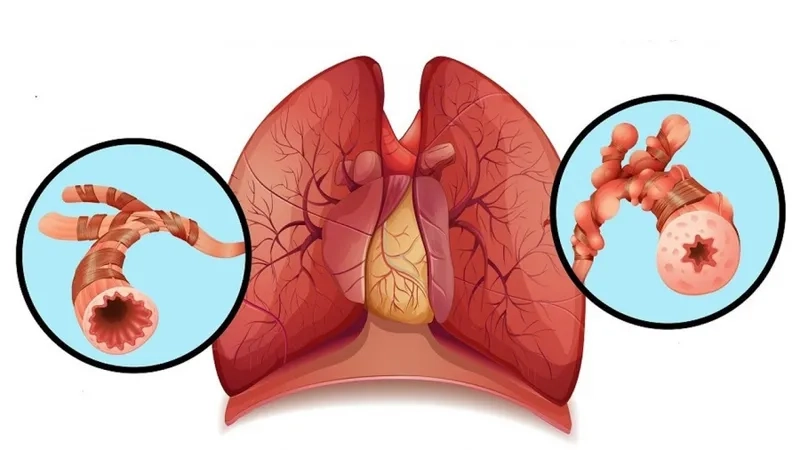 What is asthma explained in medical overview