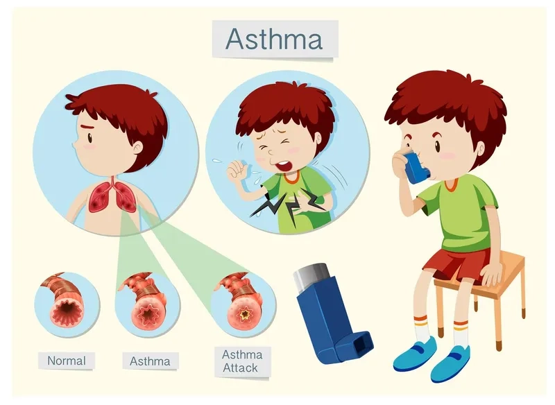 Allergic asthma triggered by environmental factors