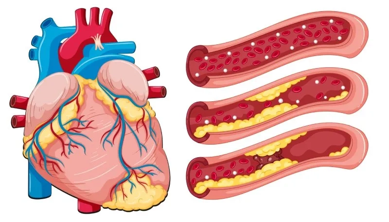 Infographic showing the causes of atherosclerosis