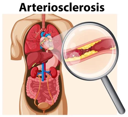 Artery cross-section with plaque buildup in arteries