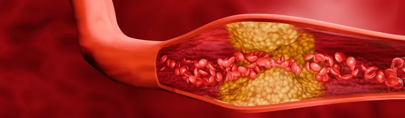 Comparing arteriosclerosis vs atherosclerosis