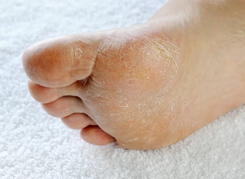 An effective athlete's foot treatment plan