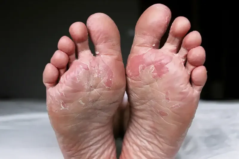 Clinical presentation of tinea pedis on the sole