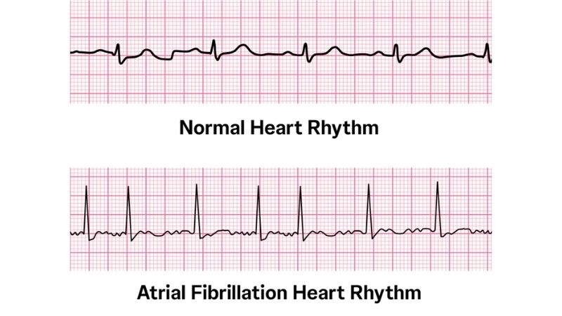 Causes of AFib rooted in heart and lifestyle factors