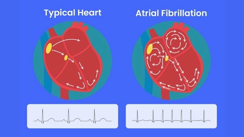 Living with AFib requires balance care and awareness