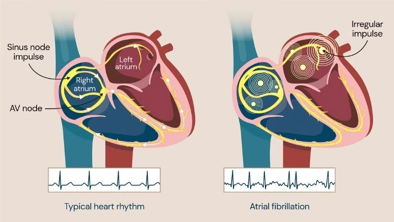Types of AFib vary from brief to persistent cases