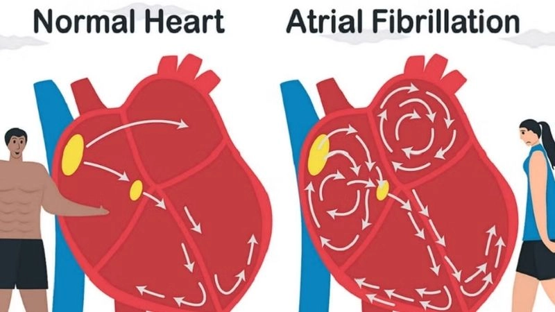 AFib and heart failure create complex cardiac challenges