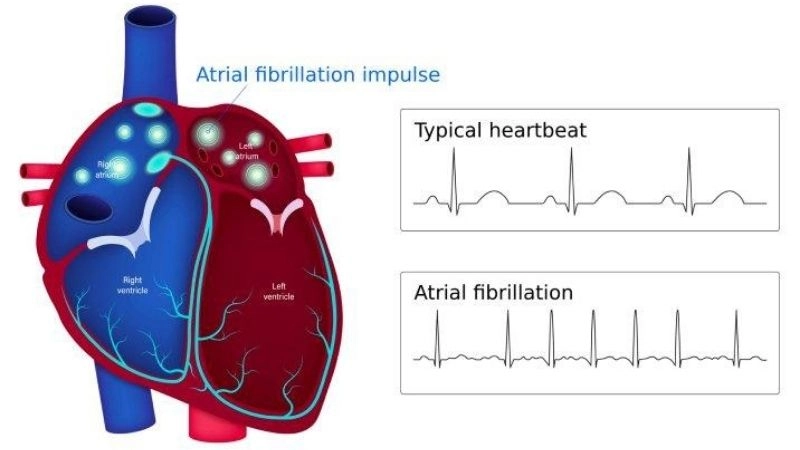 AFib and anxiety often intensify each other’s impact