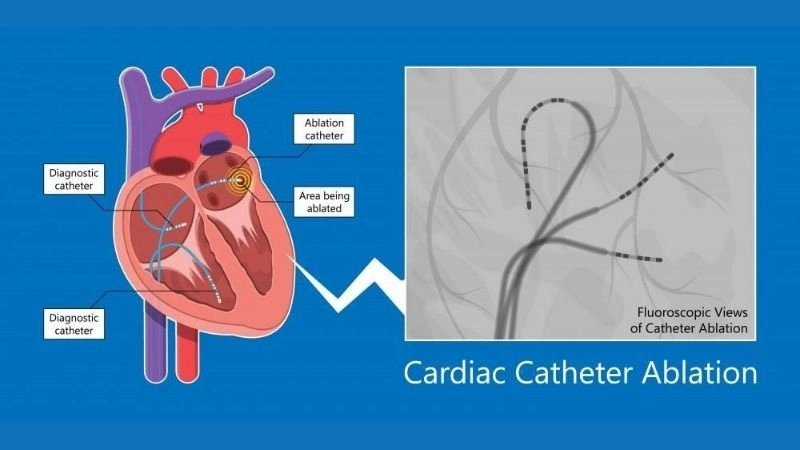AFib medication helps reduce irregular heartbeat episodes