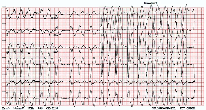 Common Atrial Fibrillation Symptoms to Recognize