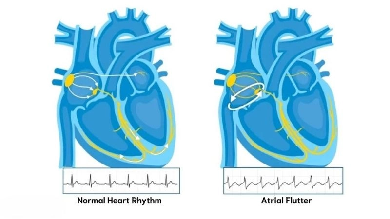 Atrial flutter symptoms include palpitations fatigue and dizziness