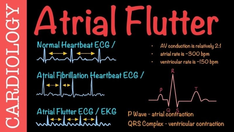 Atrial flutter treatment focuses on restoring steady rhythm