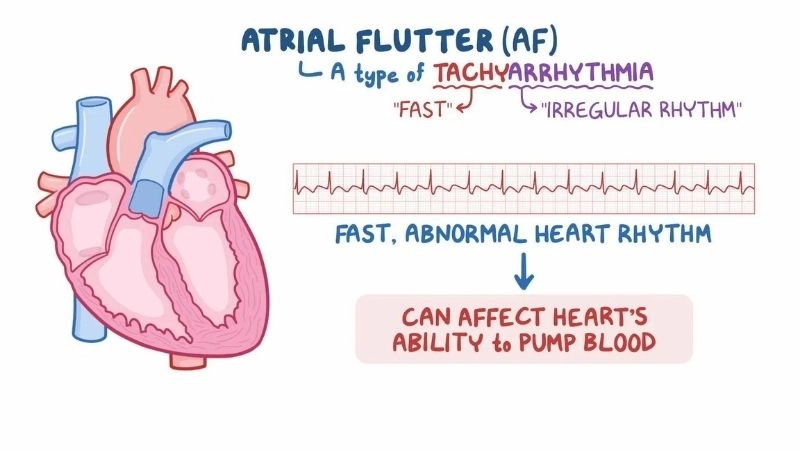Atrial flutter ablation offers lasting relief for patients