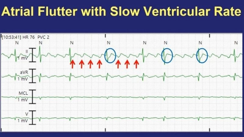 Atrial flutter causes linked to heart disease and stress