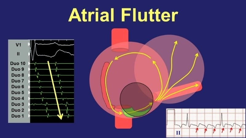 Atrial flutter EKG reveals rapid sawtooth wave patterns