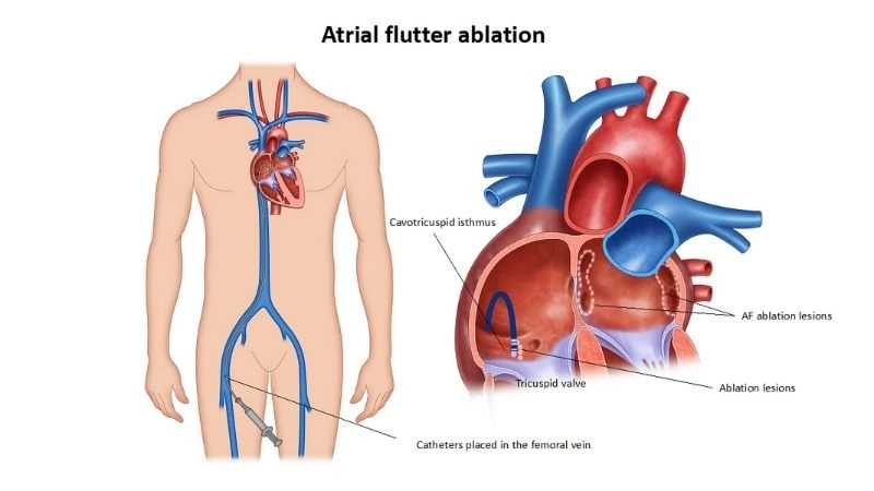 Atrial flutter and exercise require caution and guidance