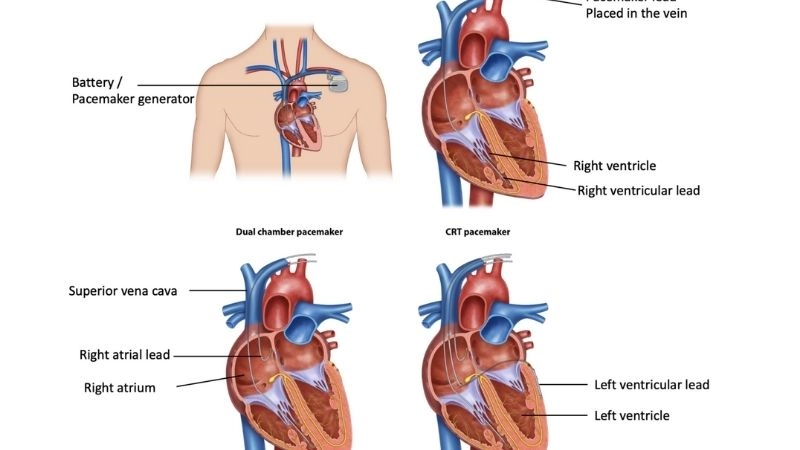 Atrial flutter vs atrial tachycardia highlights key contrasts
