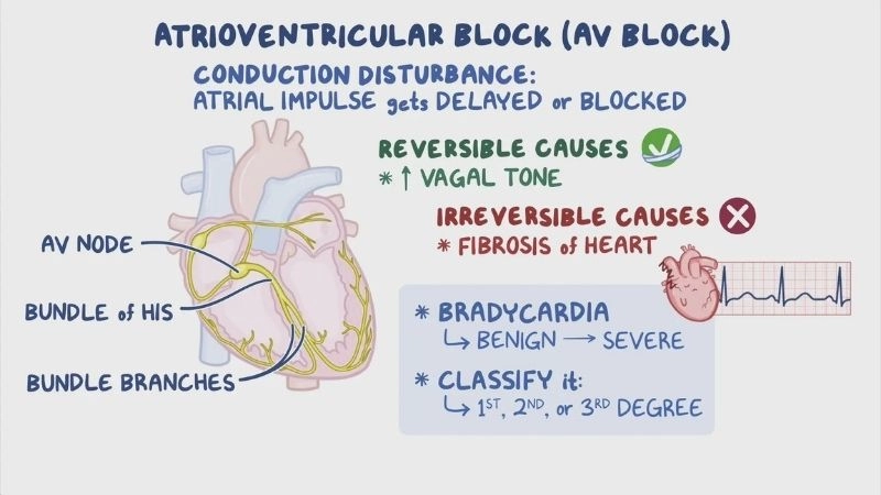 Causes of av block linked with heart weakness