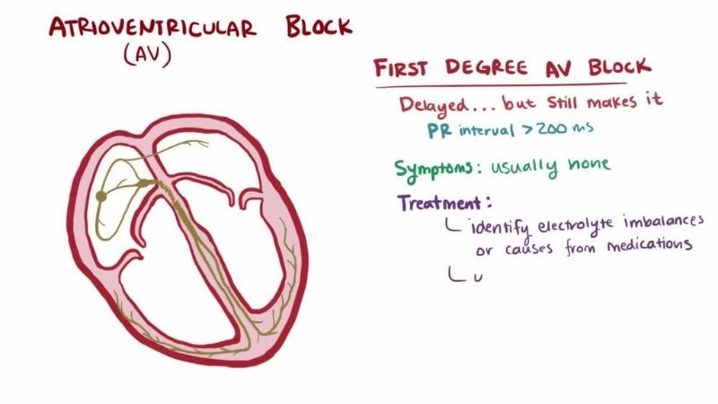 Atrioventricular block types reveal cardiac issues