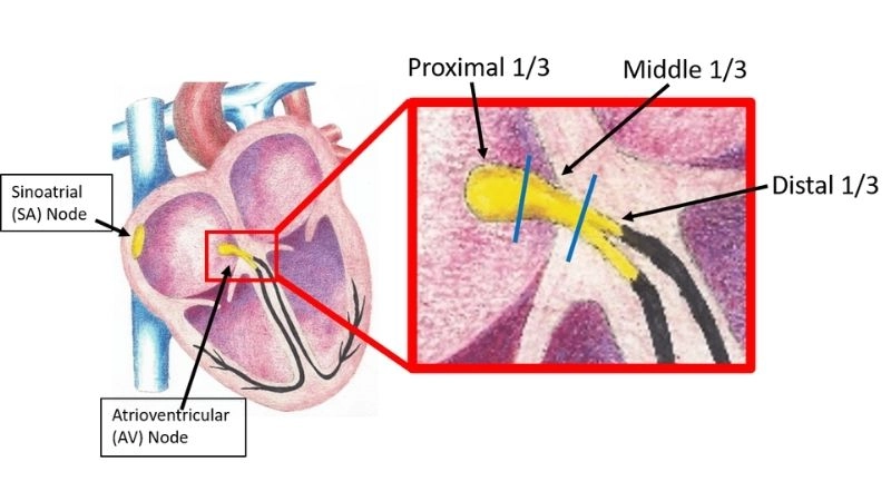 Av block treatment brings hope to weak hearts