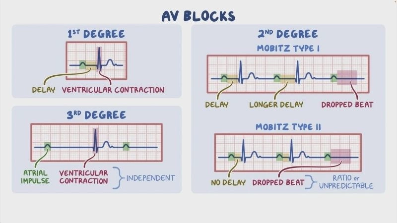 Av node block interrupts heart signal pathway