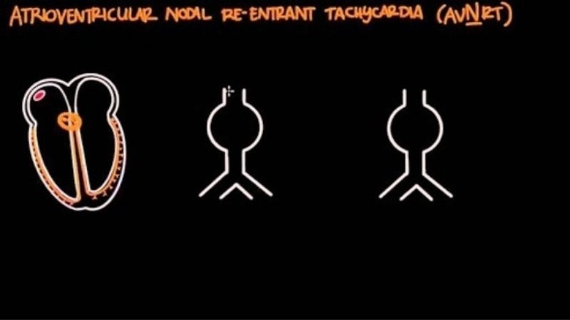 Atrioventricular Nodal Reentrant Tachycardia ECG confirms diagnosis