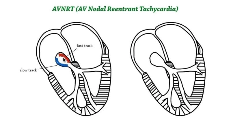 Atrioventricular Nodal Reentrant Tachycardia Diagnosis with ECG test