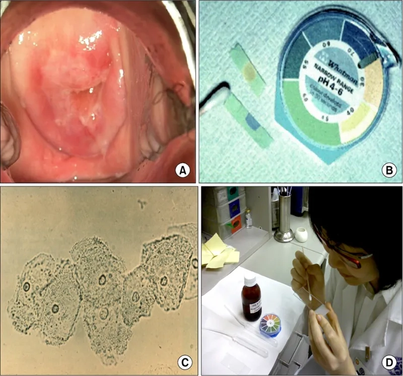 Explaining what is bacterial vaginosis (BV)