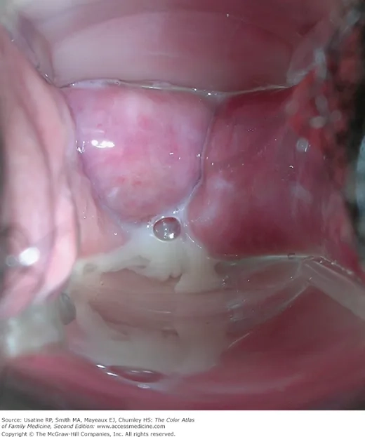 Comparing the signs of BV vs yeast infection