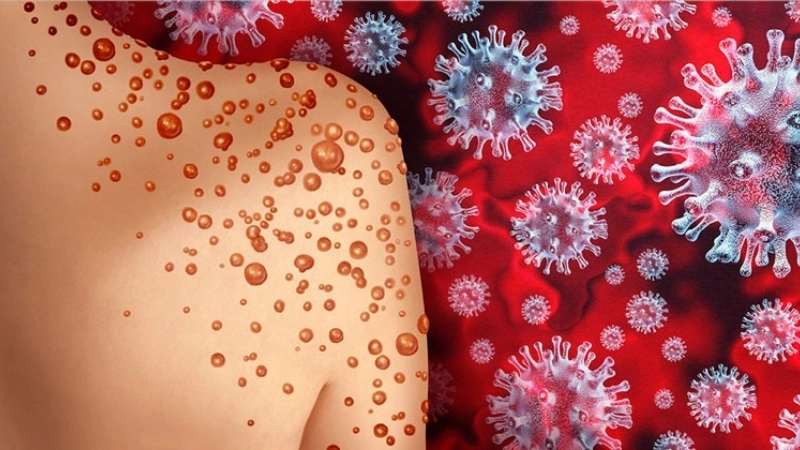 Common symptoms of Barmah Forest virus shown on a diagram