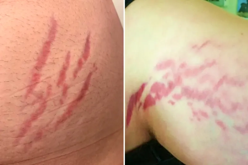 A brain scan showing the effects of neuro Bartonellosis