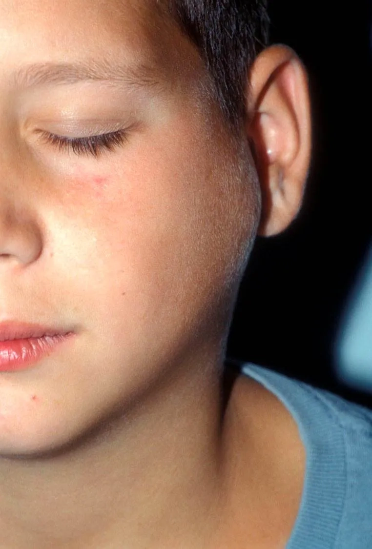 A clinical photograph of a characteristic Bartonellosis rash