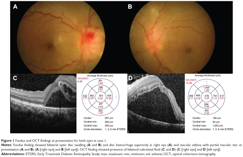 An infographic illustrating common Bartonellosis symptoms