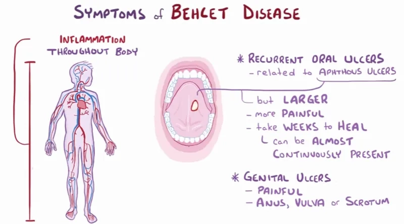 A diagram explaining what is Behçet's disease