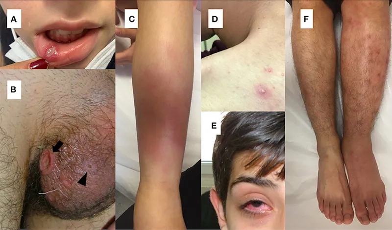 How this autoimmune disease affects blood vessels